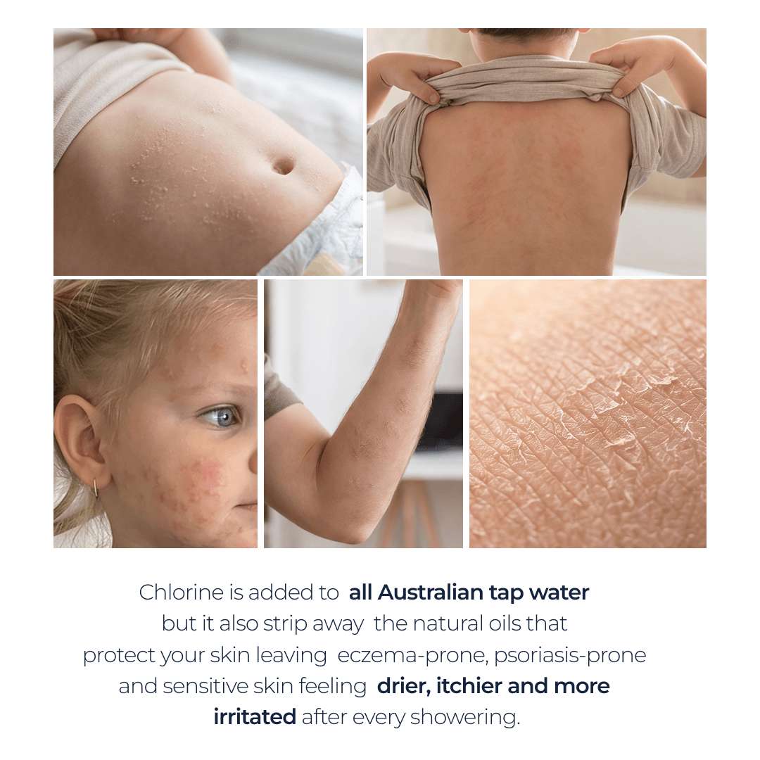 Collage showing dry, irritated and rash-prone skin with text about chlorine in Australian tap water and skin sensitivity