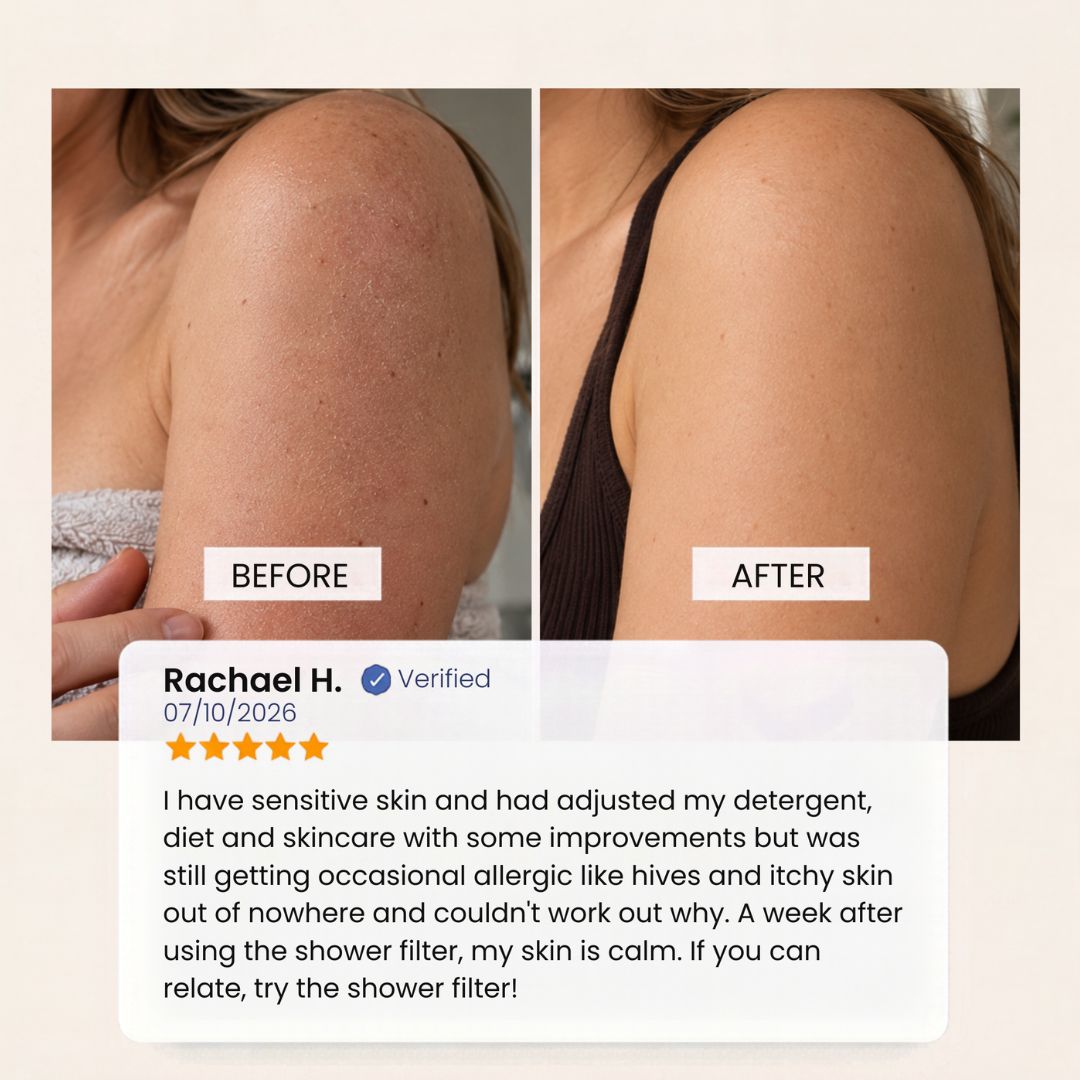 Before-and-after shoulder skin comparison with a verified Evolved H2O shower filter customer review describing calmer, less itchy sensitive skin